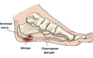 Пяточная шпора – симптомы, причины и способы лечения