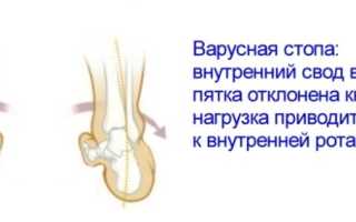 Варусная деформация стоп и голеней у взрослых