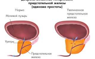 Что такое гиперплазия предстательной железы?