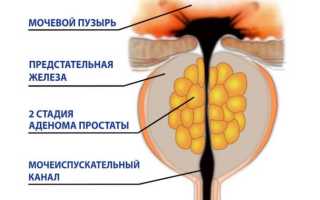 Первая и вторая стадии аденомы простаты
