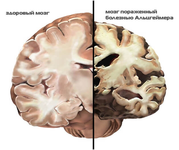 Болезнь Альгеймера