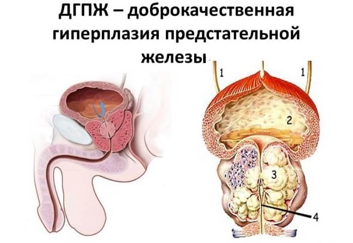 ДГПЖ симптомы