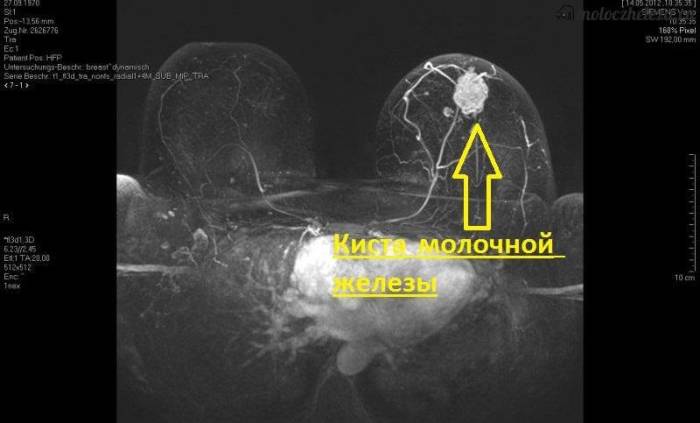 признаки кисты на обследовании узи