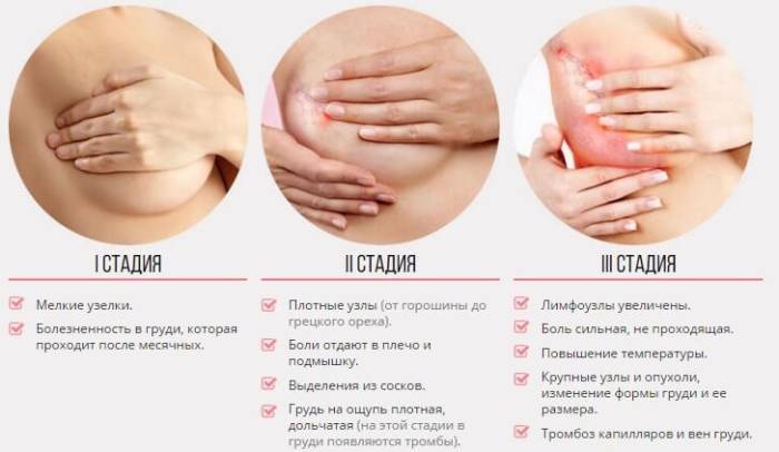 Нажмите для увеличения симптомы мастопатии молочной железы