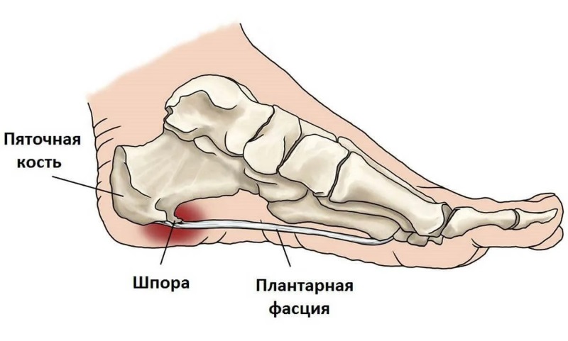шпора на пятке