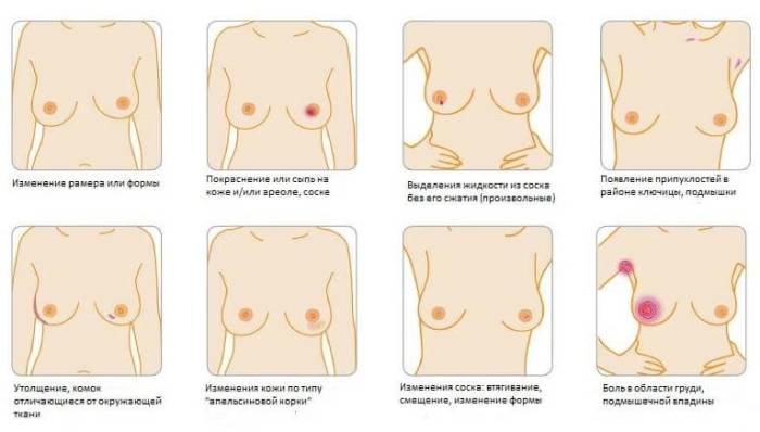 Нажмите для увеличения изображения симптомы рака груди