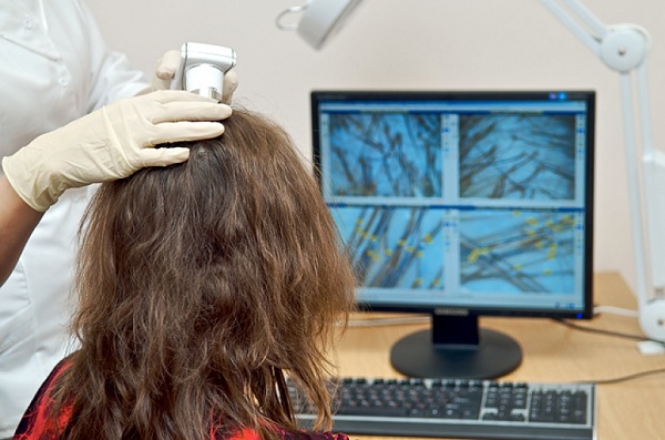 диагностирование облысения