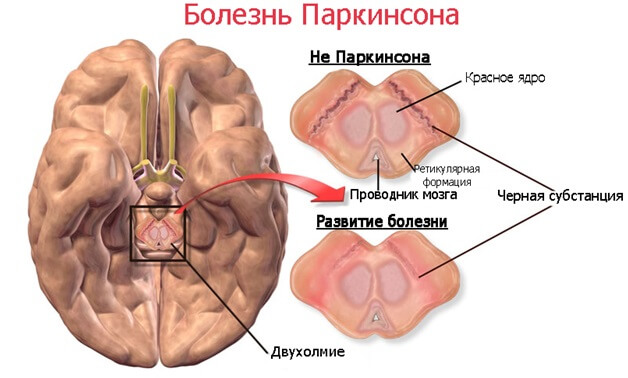 Болезнь паркинсона