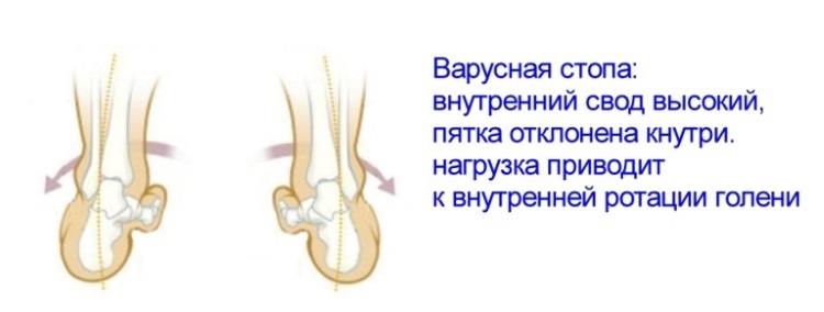 варусная деформация
